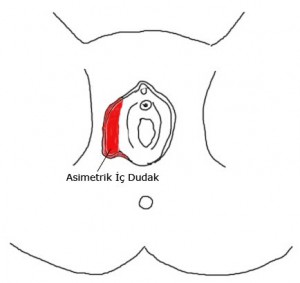 laparoskopi sonrası cinsel ilişki süresi laparoskopi sonrası cinsel ilişki süresi