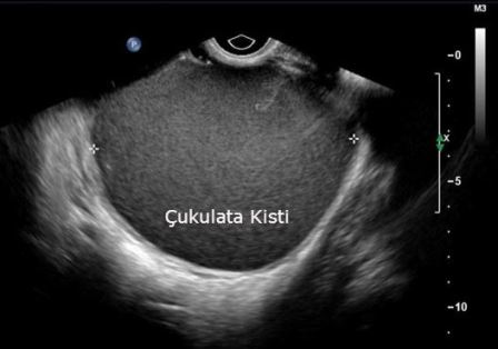 Çukulata Kistinin ultrasonografik görünümü